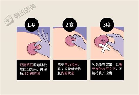 女生奶頭有毛|不懂就问：乳头长毛毛正常吗？